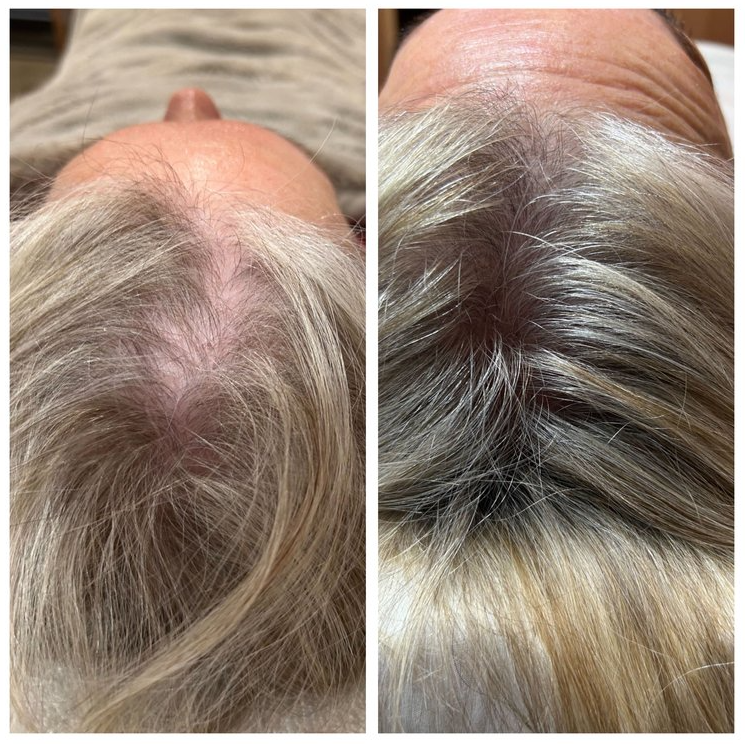 Exosome Hair Restoration | Grow Healthy Hair — Salon Cheveux